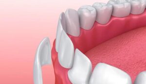 Ο Ιδανικός Υποψήφιος για Invisalign