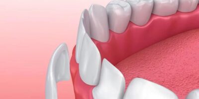 Ο Ιδανικός Υποψήφιος για Invisalign