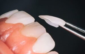 Οδηγός Γονέων για το Invisalign για Εφήβους