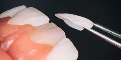 Οδηγός Γονέων για το Invisalign για Εφήβους